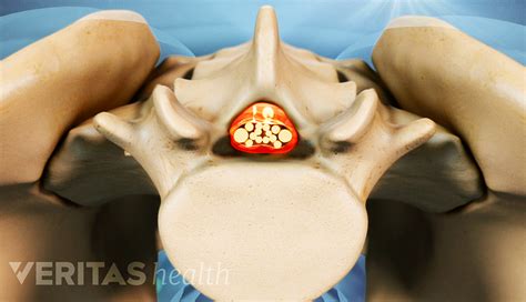 Spine Fusion Risks and Complications | Spine-health