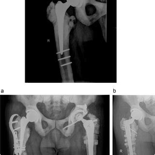 Anteroposterior Radiograph Of The Right Hip After Tha With Three Broken