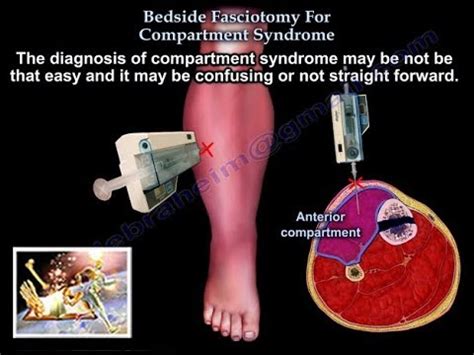 Surgical Management Of Acute Compartment Syndrome And, 47% OFF