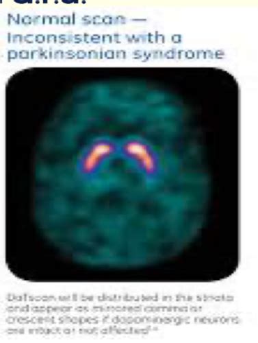 Neuro Medicine Parkinson S Disease Clinical Aspects Flashcards Quizlet