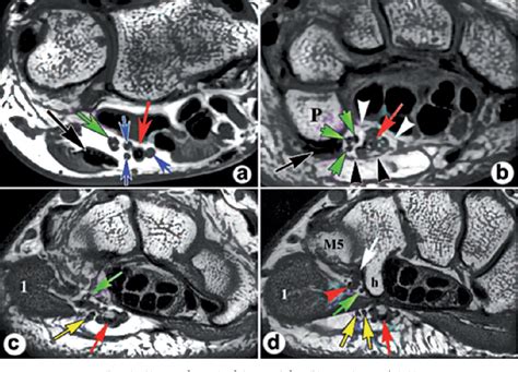 Anatomy of Guyon's canal - a systematic review. | Semantic Scholar