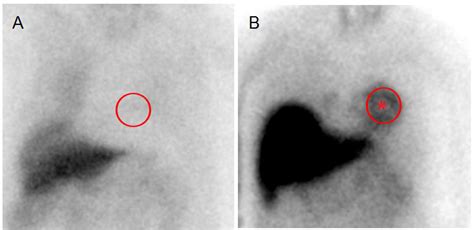 Heart Planar 123 I MIBG Scintigraphy 4 Hours Post Injection Showing