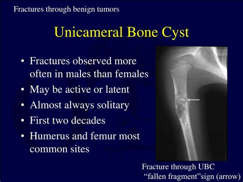 Simple Bone Cyst Fallen Fragment Sign