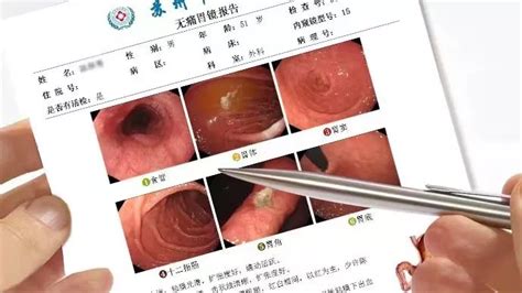 做完胃镜，胃到底有没有问题？教你快速看懂胃镜报告！ 春雨医生