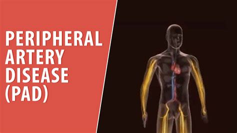 Peripheral Artery Disease