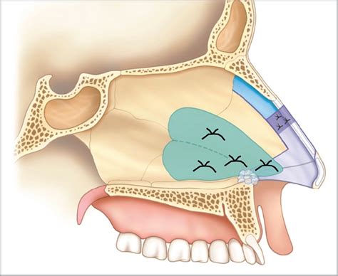 A New Nasal Septum Splint Facial Plastic Surgery Jama Facial