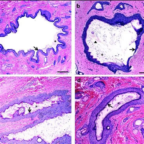 Pdf Craniofacial Dermoid Cysts Histological Analysis And Inter Site