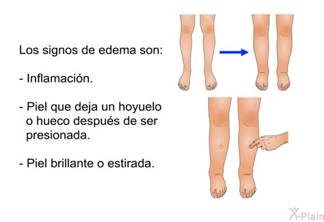 Patedu Edema De Pierna