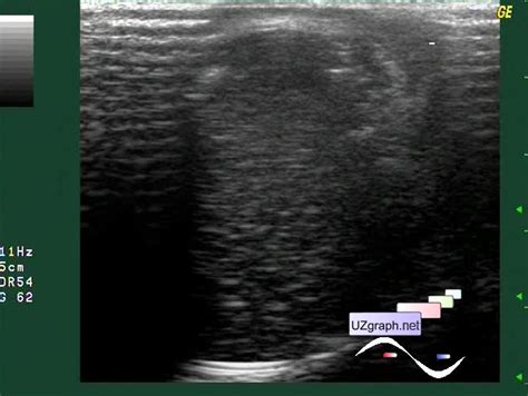 Testicular Implant Scrotum Sonography Clinical Report Video Images