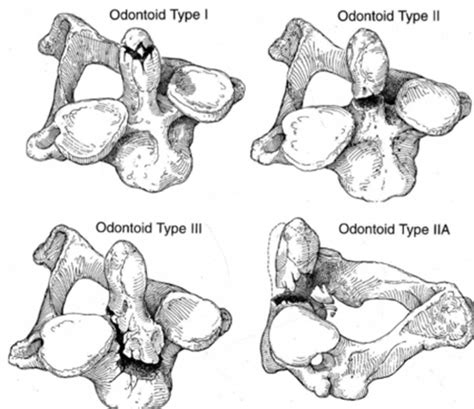 7 Principles Of Therapy For Cervical Spine Fractures Conservative Methods Surgical Techniques