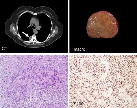 Neurogenic Tumours Of The Posterior Mediastinum And Differential