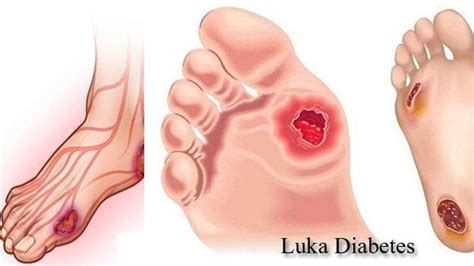 Gejala Penyakit Diabetes Ini Penyebab Dan Tanda Tanda Jika Sudah