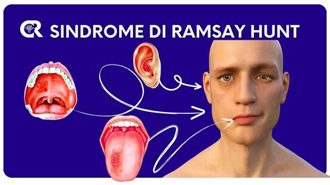 Sindrome Di Ramsay Hunt E La Paralisi Di Bell Cos Hanno In Comune