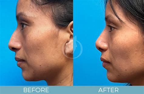 Revision Rhinoplasty Atlanta Ga Secondary Rhinoplasty Near You