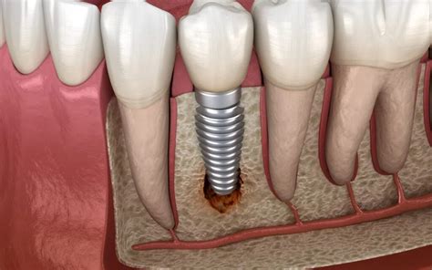 Understanding Peri Implantitis And How To Avoid It Spokane Wa