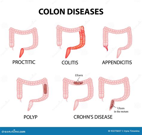 Colon Diseases Proctitis Colitis Appendicitis Polyp Ulcer Crohn`s Disease Infographics