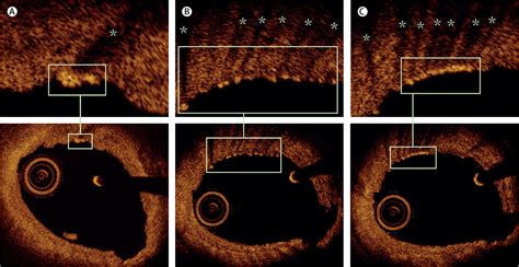 Intracoronary Artery Visualisation Of Crystalline Sirolimus Deposits