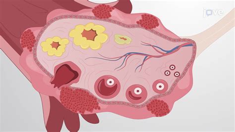 Obtaining Primary Ovarian Cancer Cells from Solid Specimens: A Method ...