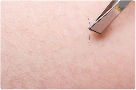 How To Deal With An Ingrown Hair Birthrepresentative14