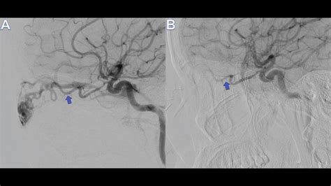 Angiography Of The Left Arteriovenous Malformation Pre Embolization