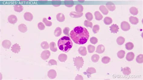 Burr Cells | Causes & Significance - Lesson | Study.com