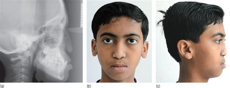 3 Orthodontic Diagnosis and Treatment Planning: Collaborating with ...