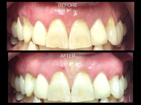 Gum Grafting For Treatment Of Receding Gums In Vancouver Burnaby BC