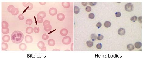 Heinz bodies vs. Howell jolly bodies | Medicine Specifics