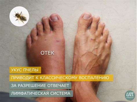 Почему отекают ноги и руки - причины и лечение с участием лимфатической ...