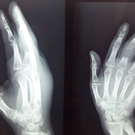 Hand x-ray of the 1 st patient at the 2 nd consultation. | Download Scientific Diagram