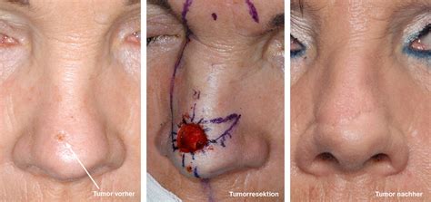 Skin Cancer Face Tumor