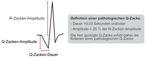 EKG Interpretation Merkmale Des Normalen EKGs P Welle QRS Komplex