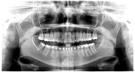 Rx Panor Mico Cirico Odontologia