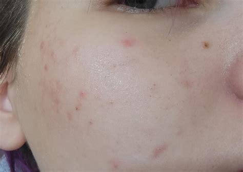 How do I get rid of/reduce my acne and blackheads? : r/SkincareAddicts