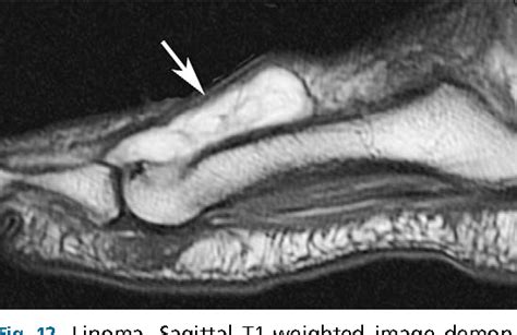 Figure 9 From Imaging Of Soft Tissue Lesions Of The Foot And Ankle Semantic Scholar