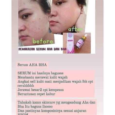 Jual ORIGINAL SERUM AHA BHA DRW SKINCARE SERUM UNTUK JERAWAT DAN BEKAS