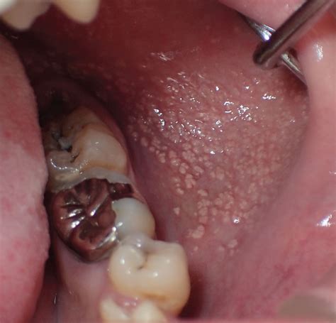 Asymptomatic Granules On The Buccal Mucosa Cleveland Clinic Journal Of Medicine