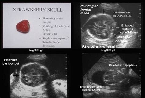 Trisomy 18 | Medical ultrasound, Obstetric ultrasound, Ultrasound technician