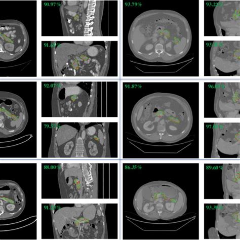 pancreas segmentation   axial sagittal  coronal