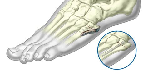 Wrist Hook Plates Ortho Providers