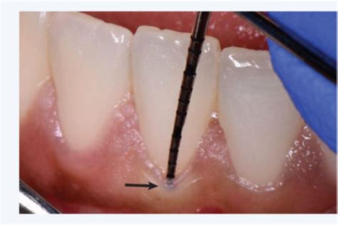 Mucogingival Deformities And Conditions Around Teeth Quiz