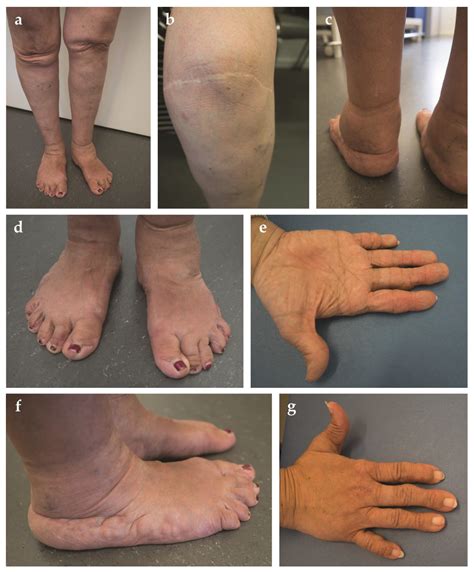 Figure From Ehlers Danlos Syndrome Hypermobility Type An Off