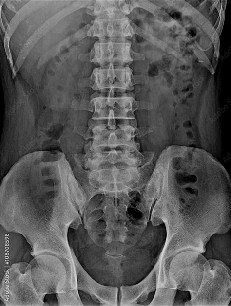 X-ray lumbo-sacral spine and pelvis Stock Photo | Adobe Stock