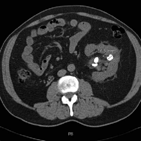 Kidney CT scan | Kaggle