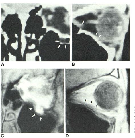 Figure From Surface Coil Mr Imaging Of Orbital Blowout Fractures A