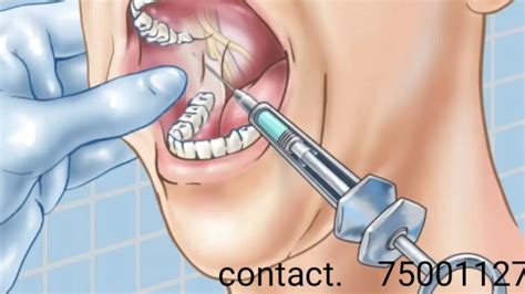 Standard Inferior Alveolar Nerve Block Youtube