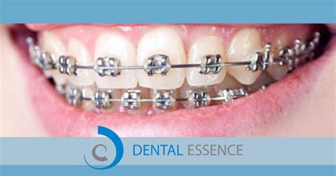 Everything You Need To Know About Braces Dentist Essendon