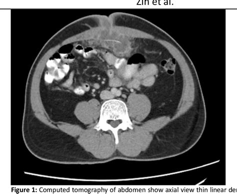 Figure 1 from Retro Umbilical Abscess Mimicking Infected Urachal Cyst: A Rare Presentation from ...