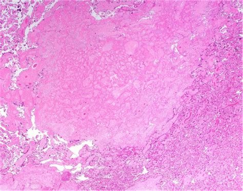 Multiple Placental Infarcts With Usual And Hypertensive Types Download Scientific Diagram