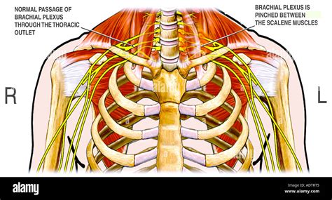 Thoracic Outlet Syndrome Stock Photo 7710148 Alamy